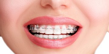 How Fast Do Damon Braces Work?